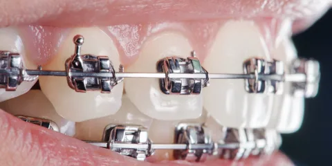 Primer plano de dientes con brackets metálicos y arco de ortodoncia