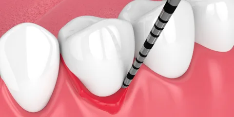 Ilustración 3D de una sonda periodontal midiendo la bolsa de una encía inflamada